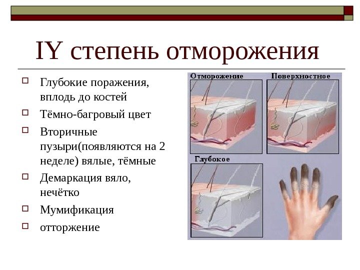  IY степень отморожения Глубокие поражения,  вплодь до костей Тёмно-багровый цвет Вторичные пузыри(появляются