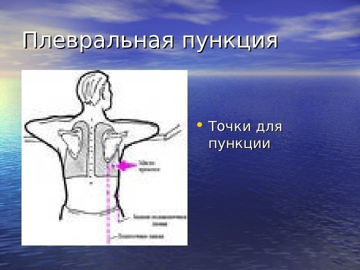   Плевральная пункция • Точки для пункции 