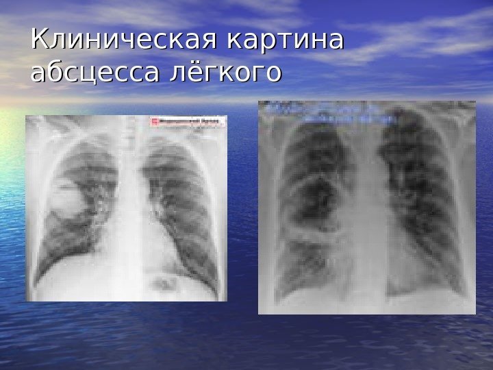   Клиническая картина абсцесса лёгкого 