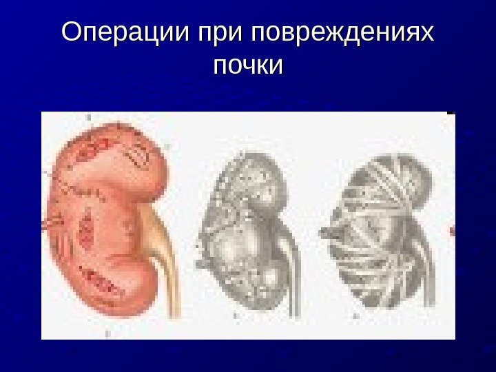   Операции при повреждениях почки 