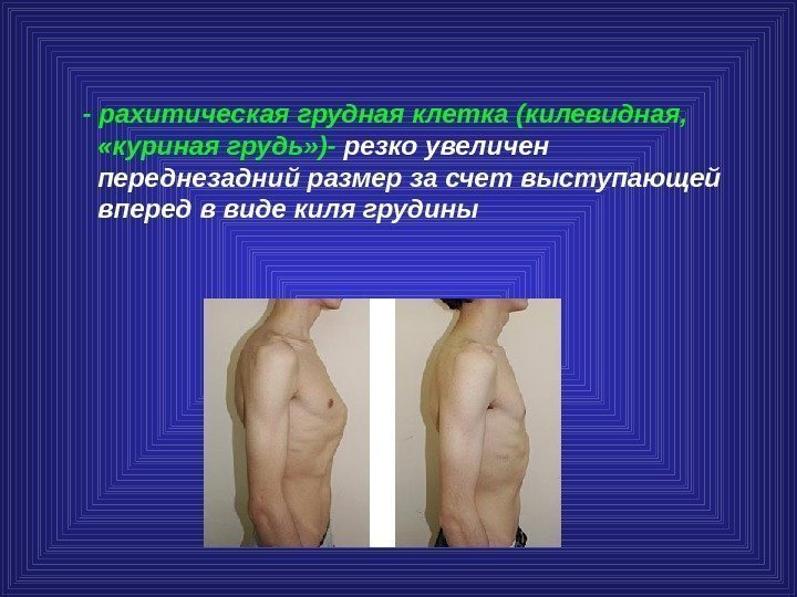  - рахитическая грудная клетка (килевидная,  «куриная грудь» )- резко увеличен переднезадний