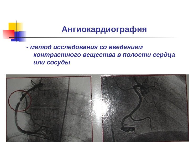 Ангиокардиография - метод исследования со введением контрастного вещества в полости сердца или сосуды 