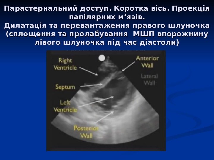 Парастернальний доступ. Коротка вісь. Проекція папілярних м ’’ язяз ів. Дилатація та перевантаження правого