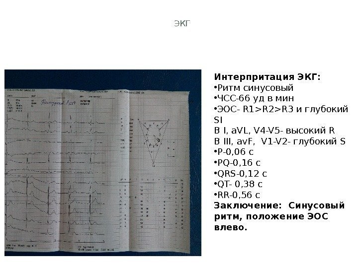 ЭКГ Интерпритация ЭКГ:  • Ритм синусовый • ЧСС-66 уд в мин • ЭОС-