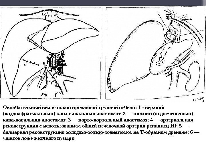 Окончательный вид имплантированной трупной печени: 1 - верхний (поддиафрагмальный) кава-кавальный анастомоз; 2 — нижний