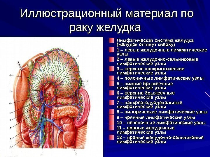   Иллюстрационный материал по раку желудка Лимфатическая система желудка (желудок оттянут кверху) 1