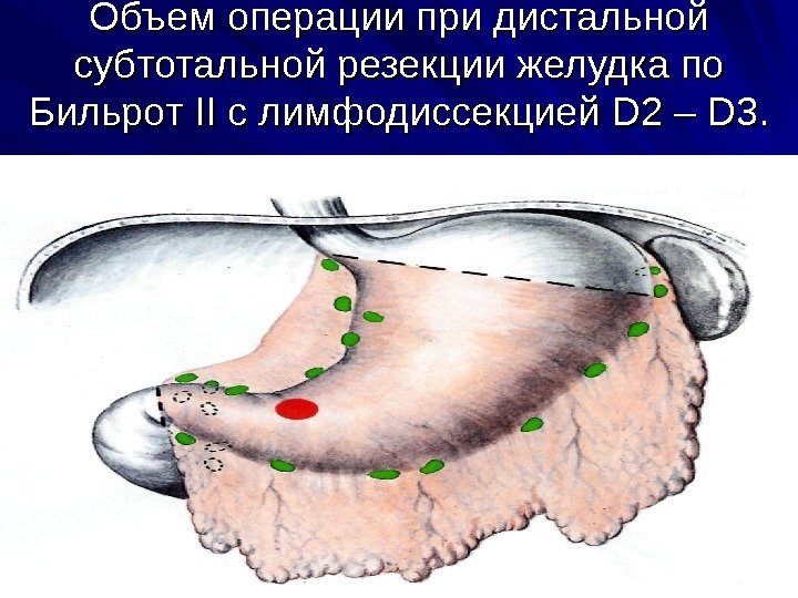 Объем операции при дистальной субтотальной резекции желудка по Бильрот IIII с лимфодиссекцией DD 2