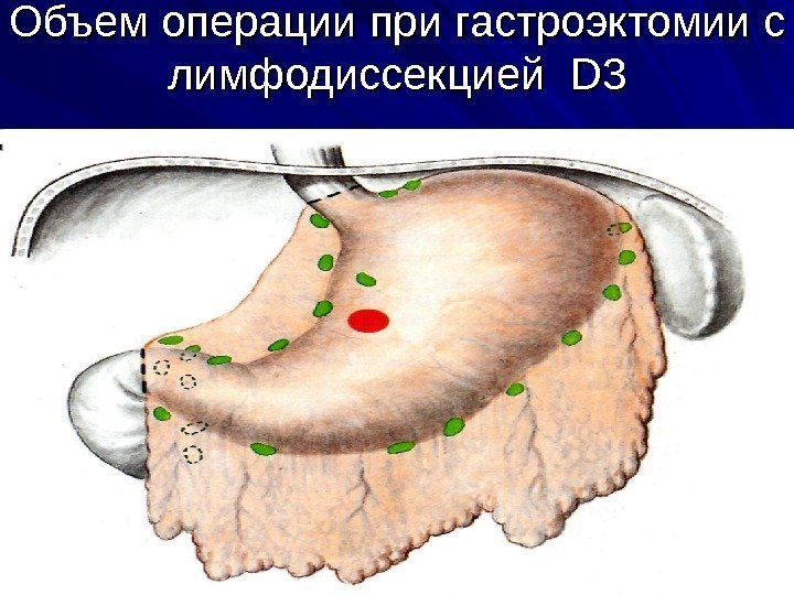 Объем операции при гастроэктомии c c лимфодиссекцией  DD 33 