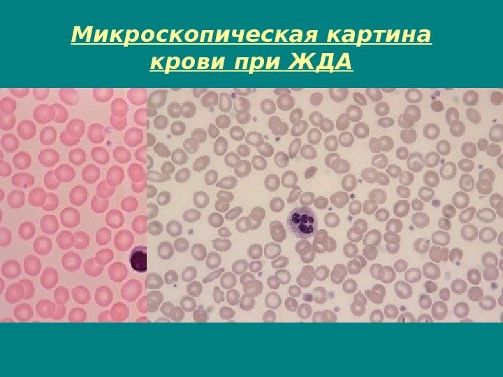 Микроскопическая картина крови при ЖДА 