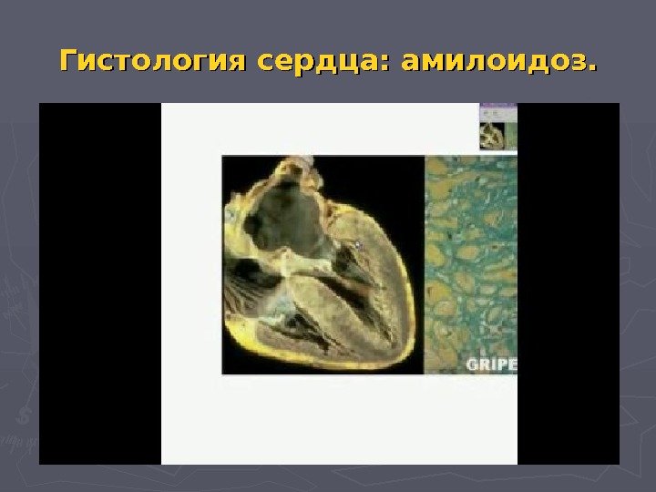 Гистология сердца: амилоидоз.  
