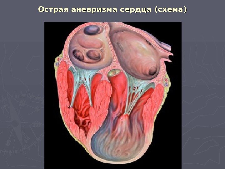 Острая аневризма сердца (схема) 