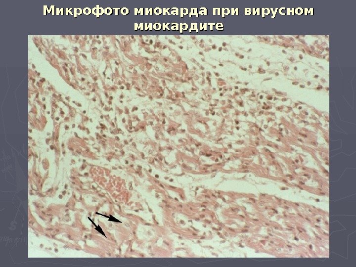 Микрофото миокарда при вирусном миокардите 