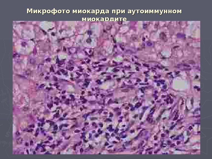 Микрофото миокарда при аутоиммунном миокардите 