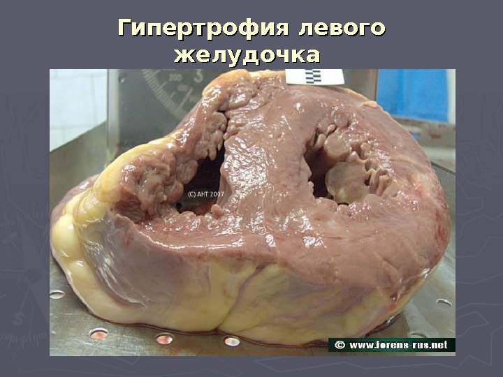 Гипертрофия левого желудочка 
