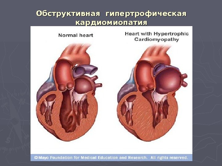 Обструктивная гипертрофическая кардиомиопатия 