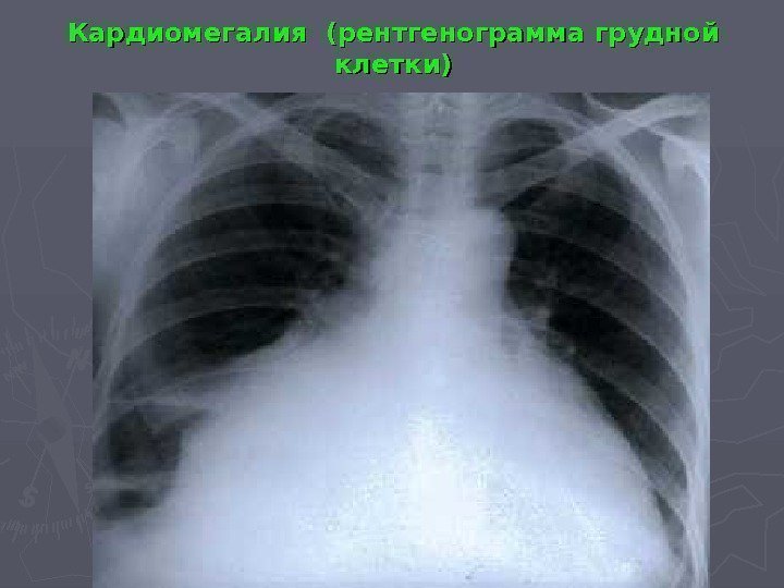 Кардиомегалия (рентгенограмма грудной клетки) 