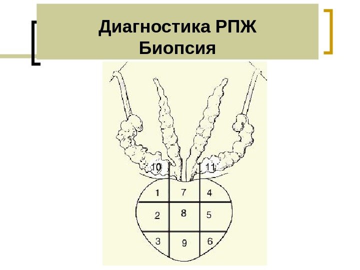 Диагностика РПЖ Биопсия 