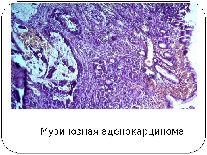 Музинозная аденокарцинома 