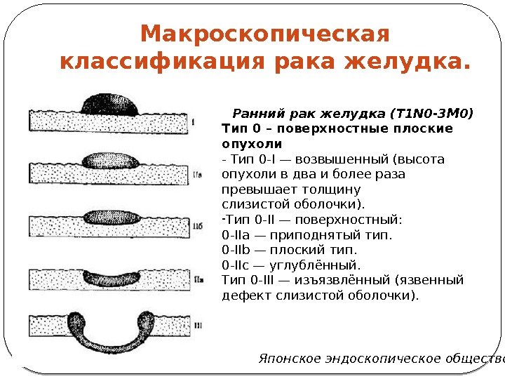 Плоская опухоль схема