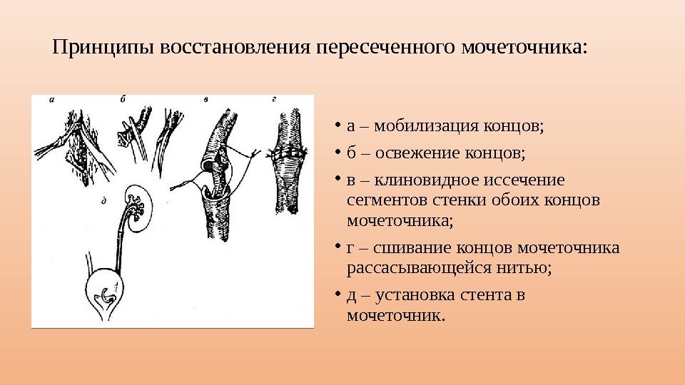 Принцип восстановления. Мобилизация мочеточника. Повреждение мочеточника при гинекологических операциях. Источник развития мочеточника. Травма мочеточника классификация.