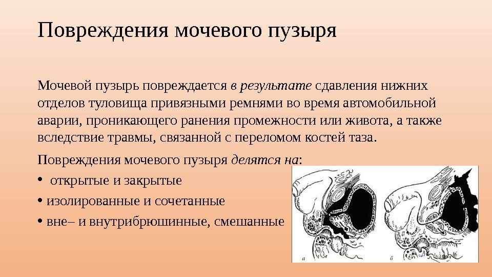 Повреждения мочевого пузыря Мочевой пузырь повреждается в результате сдавления нижних отделов туловища привязными ремнями