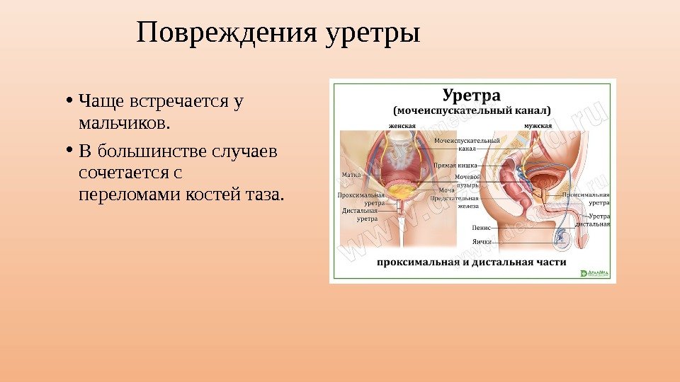 Повреждения уретры • Чаще встречается у мальчиков.  • В большинстве случаев сочетается с