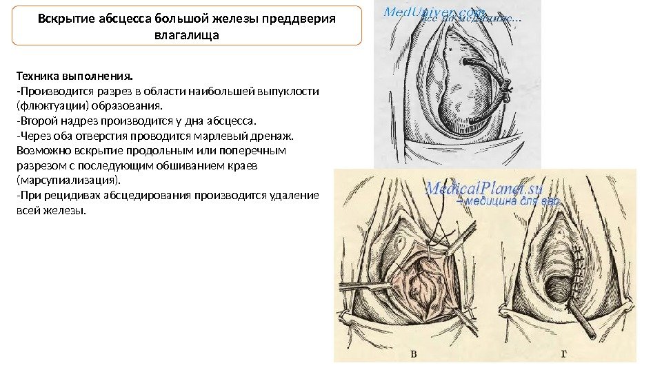 Вскрытие абсцесса большой железы преддверия влагалища Техника выполнения.  - Производится разрез в области