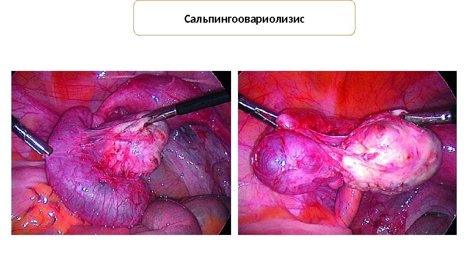 Сальпингоовариолизис 