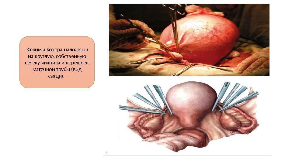 Зажимы Кохера наложены на круглую, собственную связку яичника и перешеек маточной трубы (вид сзади).