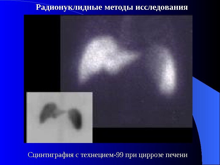 Сцинтиграфия с технецием-99 при циррозе печени Радионуклидные методы исследования 