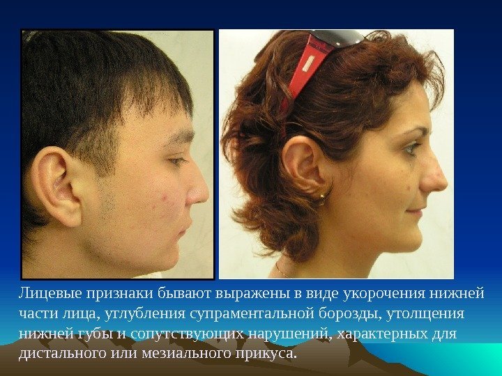 Лицевые признаки бывают выражены в виде укорочения нижней части лица, углубления супраментальной борозды, утолщения
