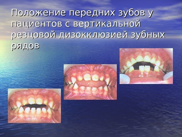   Положение передних зубов у пациентов с вертикальной резцовой дизокклюзией зубных рядов 