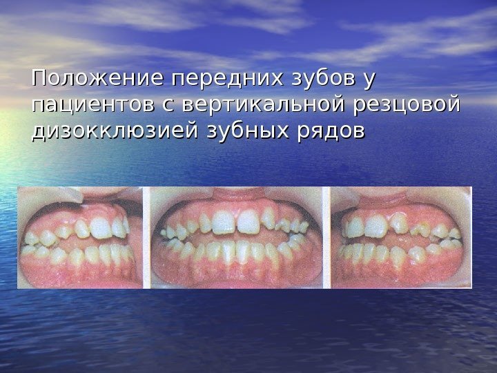  Положение передних зубов у пациентов с вертикальной резцовой дизокклюзией зубных рядов 