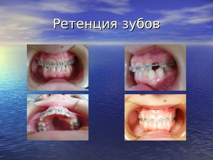   Ретенция зубов 