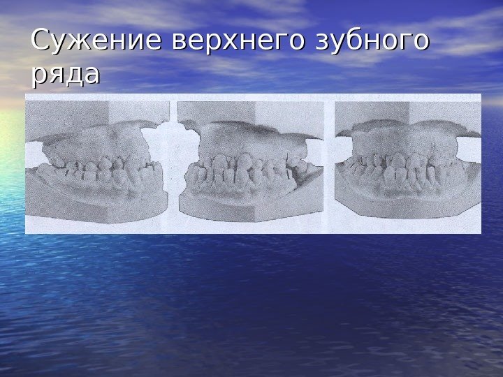   Сужение верхнего зубного ряда 