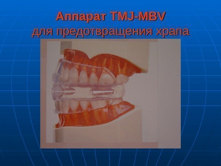   Аппарат TMJ-MBV для предотвращения храпа 