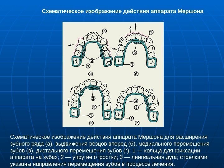   Схематическое изображение действия аппарата Мершона для расширения зубного ряда (а), выдвижения резцов
