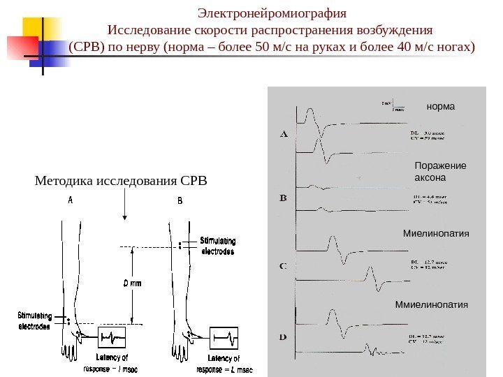 Электронейромиография Исследование скорости распространения возбуждения (СРВ) по нерву (норма – более 50 м/с на