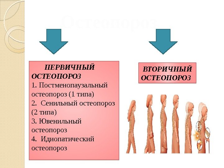 Остеопороз  ПЕРВИЧНЫЙ  ОСТЕОПОРОЗ 1. Постменопаузальный остеопороз (1 типа) 2.  Сенильный остеопороз