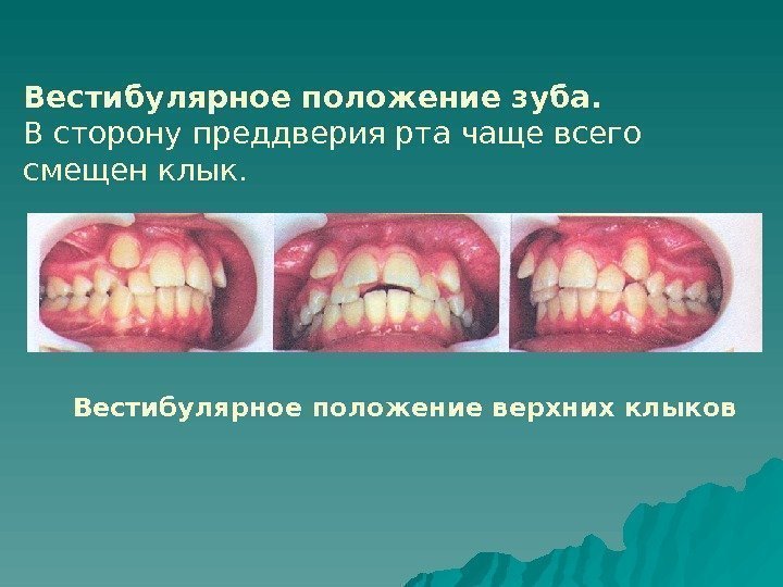   Вестибулярное положение зуба.  В сторону преддверия рта чаще всего смещен клык.
