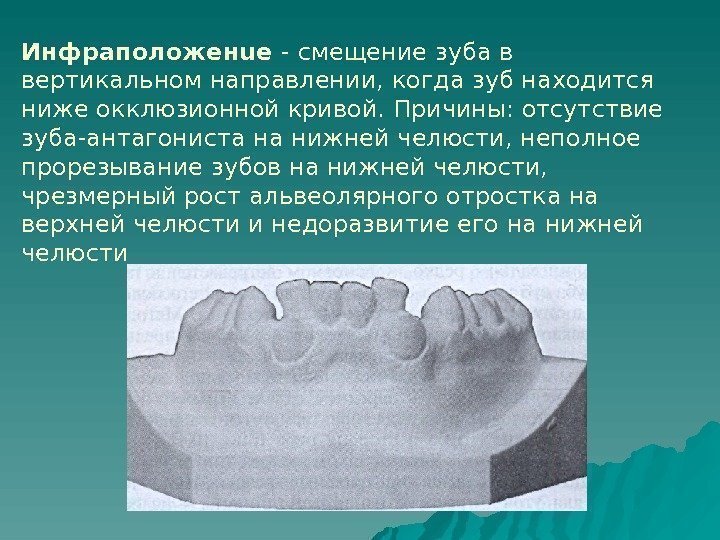   Инфраположенuе - смещение зуба в вертикальном направлении, когда зуб находится ниже окклюзионной