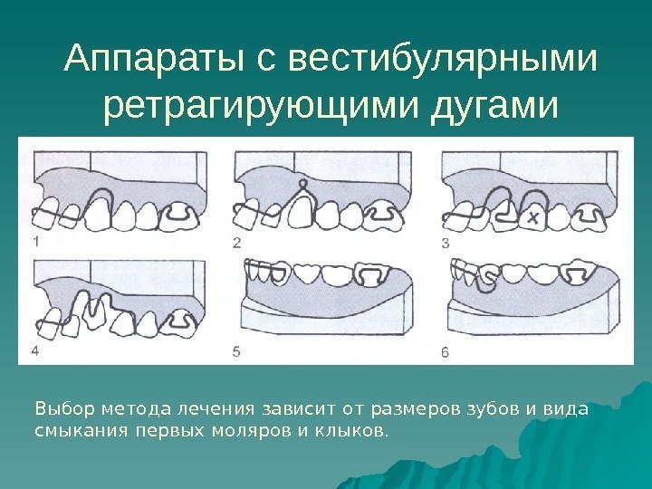   Аппараты с вестибулярными ретрагирующими дугами Выбор метода лечения зависит от размеров зубов