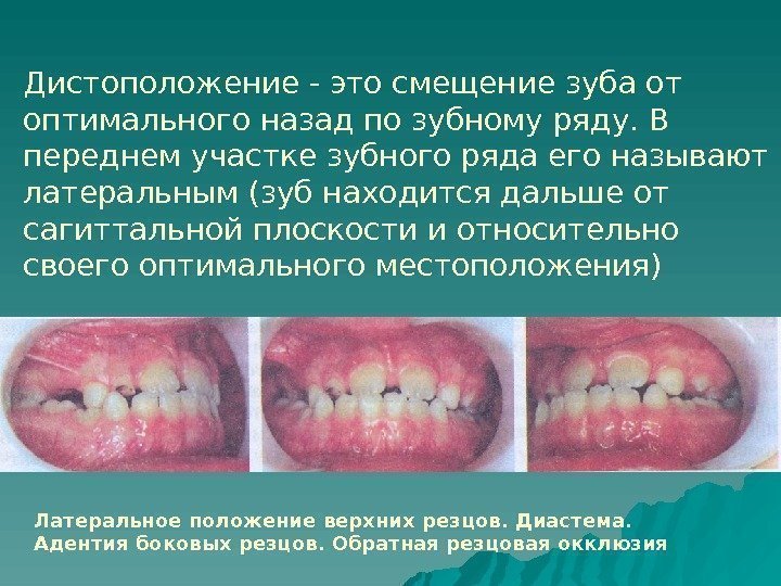   Дистоположение - это смещение зуба от оптимального назад по зубному ряду. В
