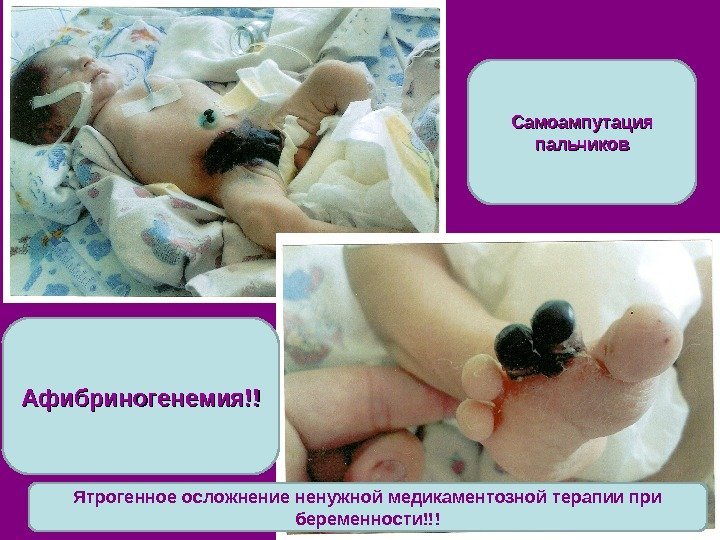 Самоампутация пальчиков Афибриногенемия!! Ятрогенное осложнение ненужной медикаментозной терапии при беременности!!! 