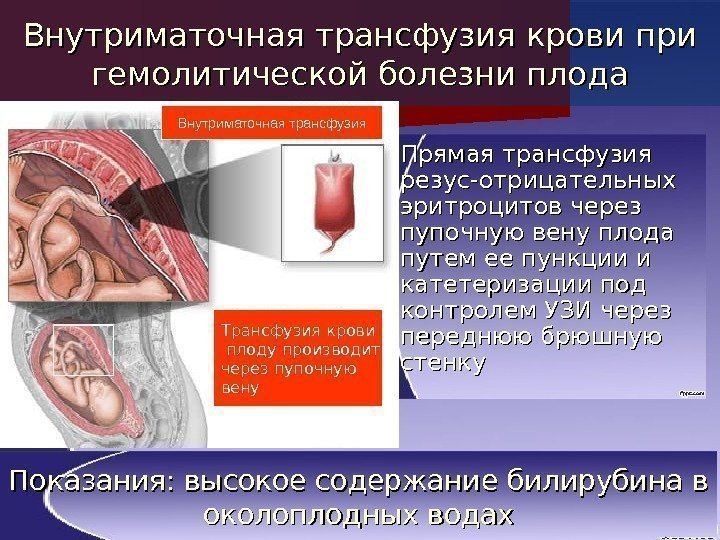 Внутриматочная трансфузия крови при гемолитической болезни плода Прямая трансфузия резус-отрицательных эритроцитов через пупочную вену