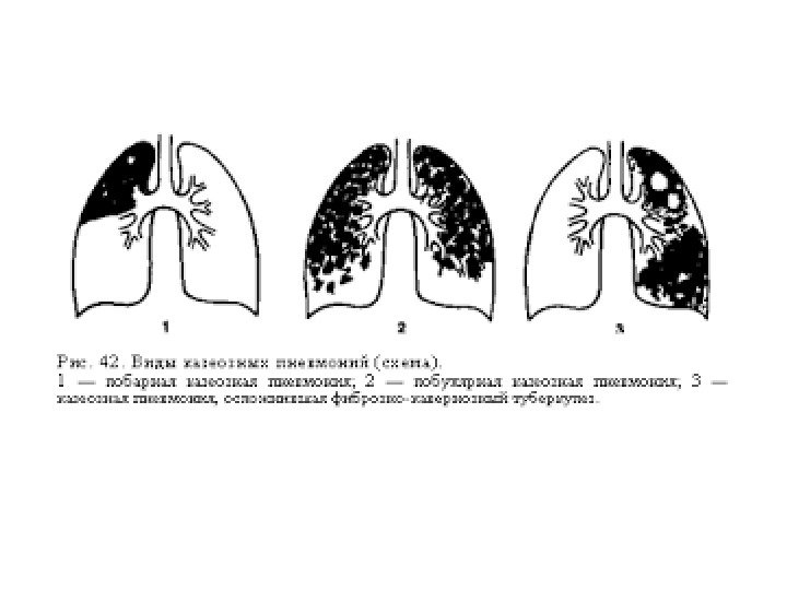 Пневмония верхней доли легкого. Двусторонняя мелкоочаговая пневмония. Схема острой пневмонии средней доли. Острая мелкоочаговая пневмония схема. Острая пневмония средней доли.