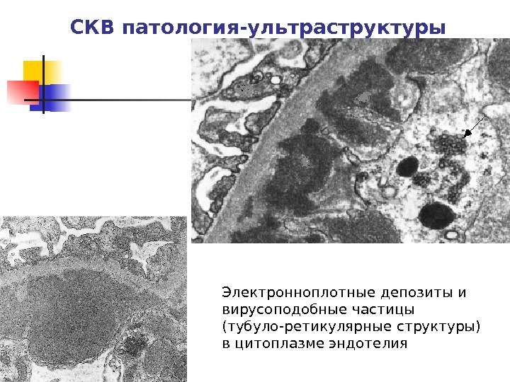 СКВ  патология-ультраструктуры Электронноплотные депозиты и вирусоподобные частицы (тубуло-ретикулярные структуры)  в цитоплазме эндотелия