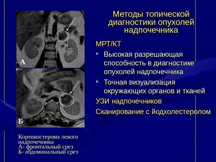   Методы топической диагностики опухолей надпочечника МРТ/КТ • Высокая разрешающая способность в диагностике