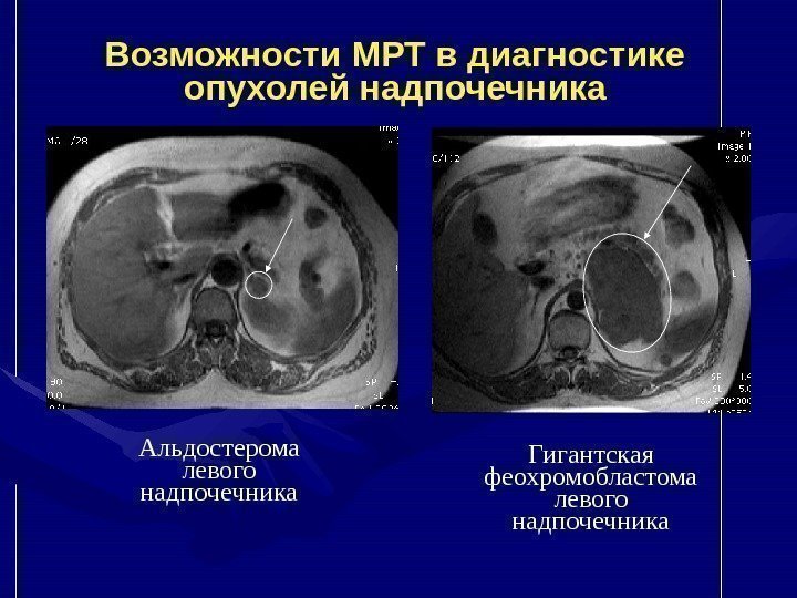   Альдостерома левого надпочечника. Возможности МРТ в диагностике опухолей надпочечника Гигантская феохромобластома левого