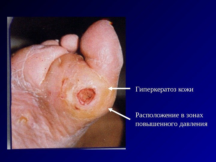 Гиперкератоз кожи Расположение в зонах повышенного давления 